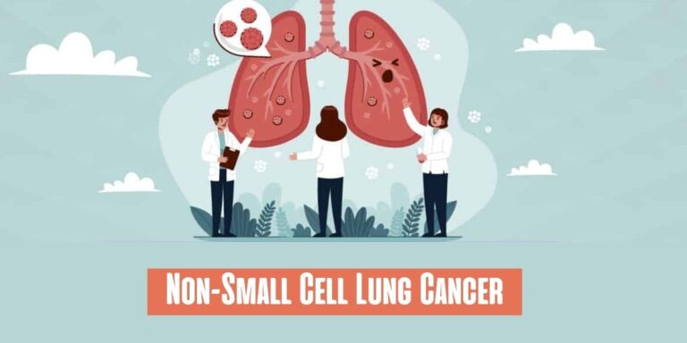 Non-Small Cell Lung Cancer