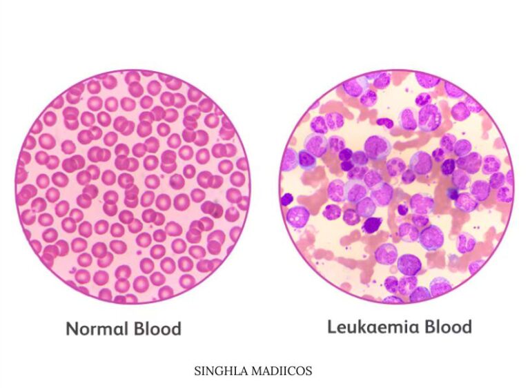 Leukemia