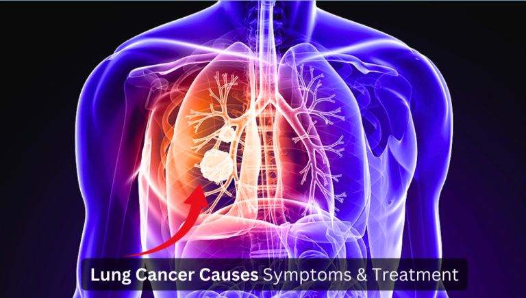 Lung Cancer Causes Symptoms & Treatment