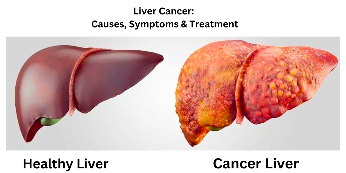 Liver Cancer